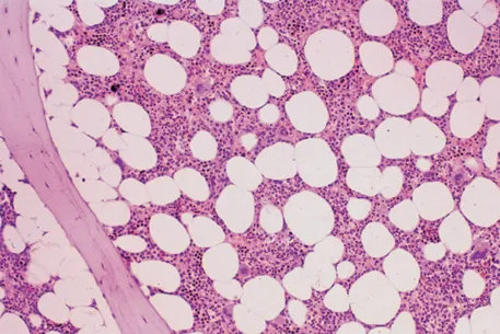 The illustration shows a normal bone marrow trephine biopsy. It shows 50 percent of intertrabecular tissue and 50 percent of fat.