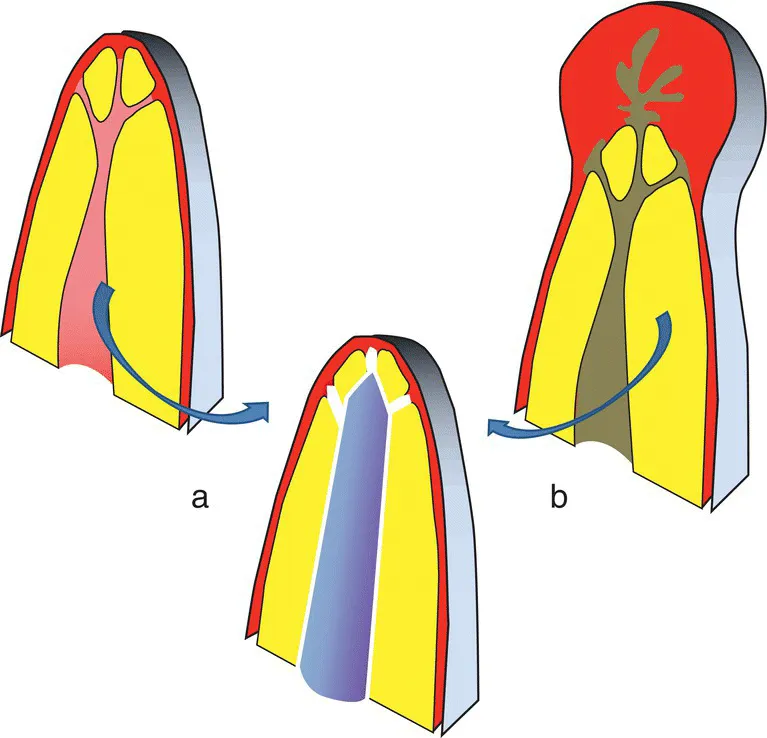 Schematic illustrations of a pulp extirpation (a) prevents and root canal disinfection (b) cures apical periodontitis.
