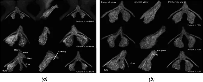 Figure 1.1 3-D MRI reconstruction of the clitoris in three women without (a) and with (b) FGM/C involving the excision of the clitoris.