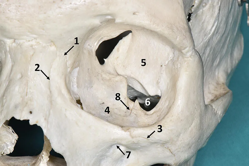 Photo depicts the anterior view of orbit in which frontomaxillary suture, nasomaxillary suture, zygomaticomaxillary suture, superior surface of the maxillary body, greater wing of the sphenoid bone, infraorbital fissure, infraorbital foramen, infraorbital groove are marked.