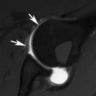 Figure showing FS T1W SE direct MR arthrogram image in the ABER position showing the anterior band of the IGHL (arrows).