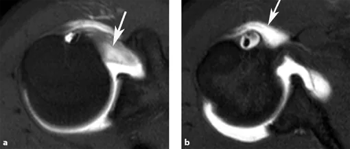 Figure showing axial FS T1W SE direct MR arthrogram images following anterior injection showing extravasation of contrast into (a) the subscapularis tendon (arrow), (b) the a b subdeltoid bursa (arrow).
