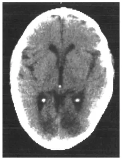 FIGURE 1.2 CT scan, June 1984, showing bilateral occipital infarction.