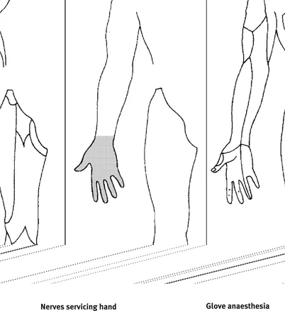 Figure 1.2 Glove anaesthesia (Erdelyi 1985, p. 3)