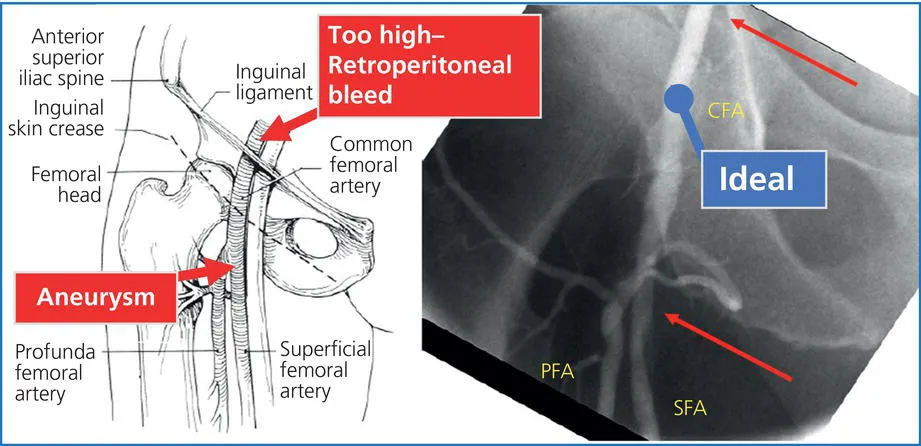 Diagram depicting the ideal location for puncture of the femoral artery, with lines marking the common femoral artery, femoral head, inguinal ligament, etc. A corresponding angiogram is depicted at the right.