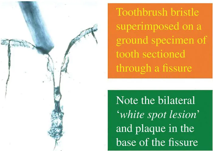 Photo depicts a fissure with a toothbrush bristle placed on it.