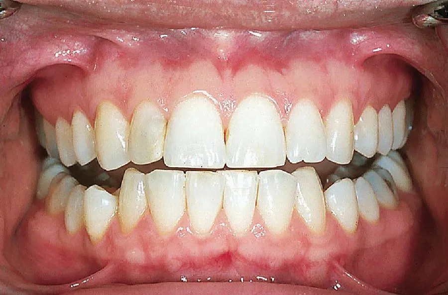 Photo depicts a healthy mouth of a with clear tooth.