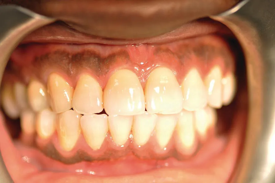 Photo depicts a healthy mouth of a with clear tooth.