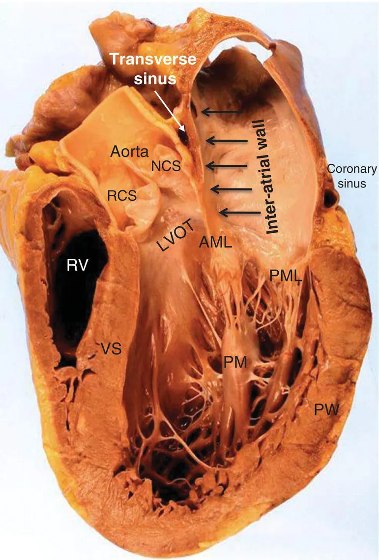 Photo depicts long axis view of the heart demonstrating the fibrous continuity of the anterior leaflet with the non-coronary sinus. The atrioventricular junction is shown in the longitudinal view; the interatrial septal wall (arrows) is separated by the transverse sinus from the aorta.