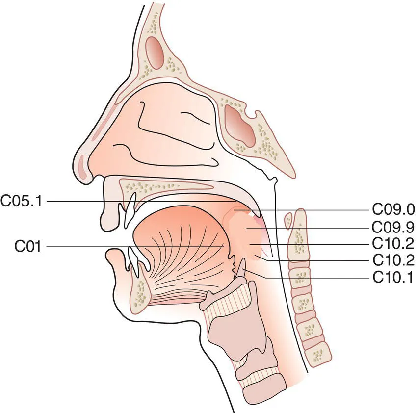 Schematic illustration of Inferior surface of soft palate, Base of tongue (posterior to the vallate papillae or posterior third),Lateral wall, Tonsil, Tonsillar fossa (C09.0) and tonsillar (faucial) pillars, Glossotonsillar sulci (tonsillar pillars)