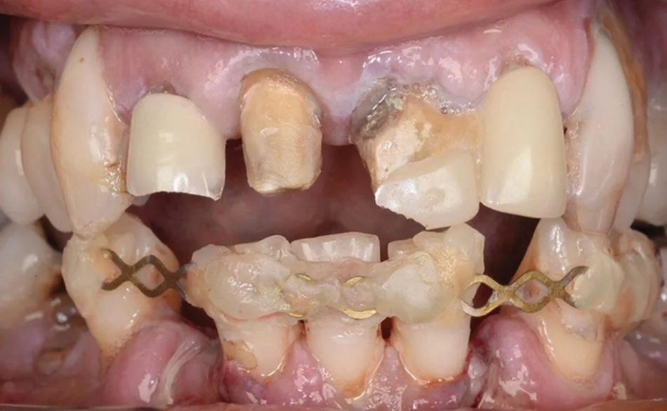 Photo depicts the heavily restored dentition following dental trauma with numerous fractured and debonded restorations.
