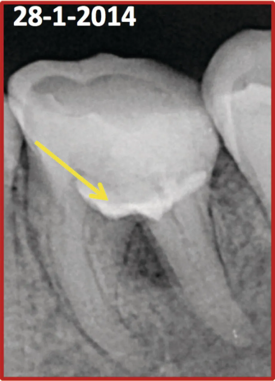 Photo depicts a radiograph showing M T A placed on the pulpal floor.