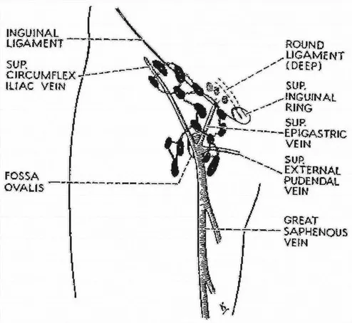 FIGURE 1.5 Depiction of inguinal nodes (a) and pelvic nodes (b) by Stanley Way8 in 1951. The relationship of the nodal groups, including direct clitoral drainage to ‘deep femoral’ nodes and contralateral labial drainage, envisaged by Way in schematic form (c – redrawn for clarity).