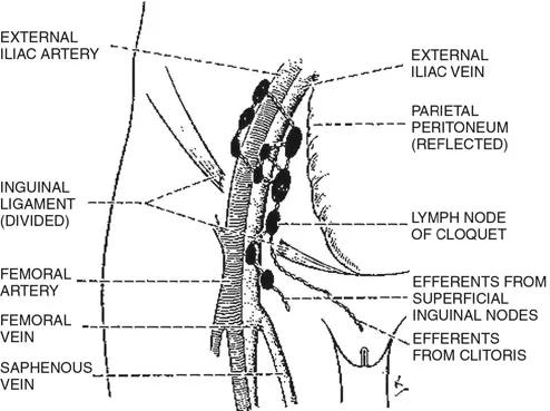 FIGURE 1.5 Depiction of inguinal nodes (a) and pelvic nodes (b) by Stanley Way8 in 1951. The relationship of the nodal groups, including direct clitoral drainage to ‘deep femoral’ nodes and contralateral labial drainage, envisaged by Way in schematic form (c – redrawn for clarity).