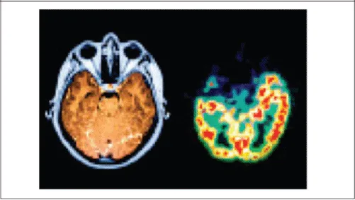 Figure 1.4. Comparison of MRI and PET Scans