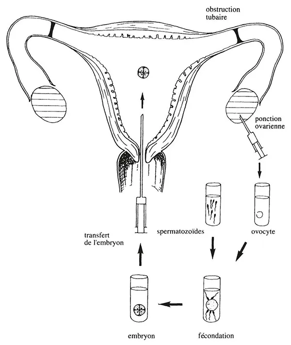  Fécondation in vitro