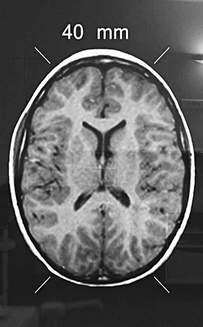 Dans 70 % des cas, l’exposition à l’atrazine provoque une diminution de la taille du crâne des bébés : jusqu’à 40 millimètres de circonférence crânienne en moins.