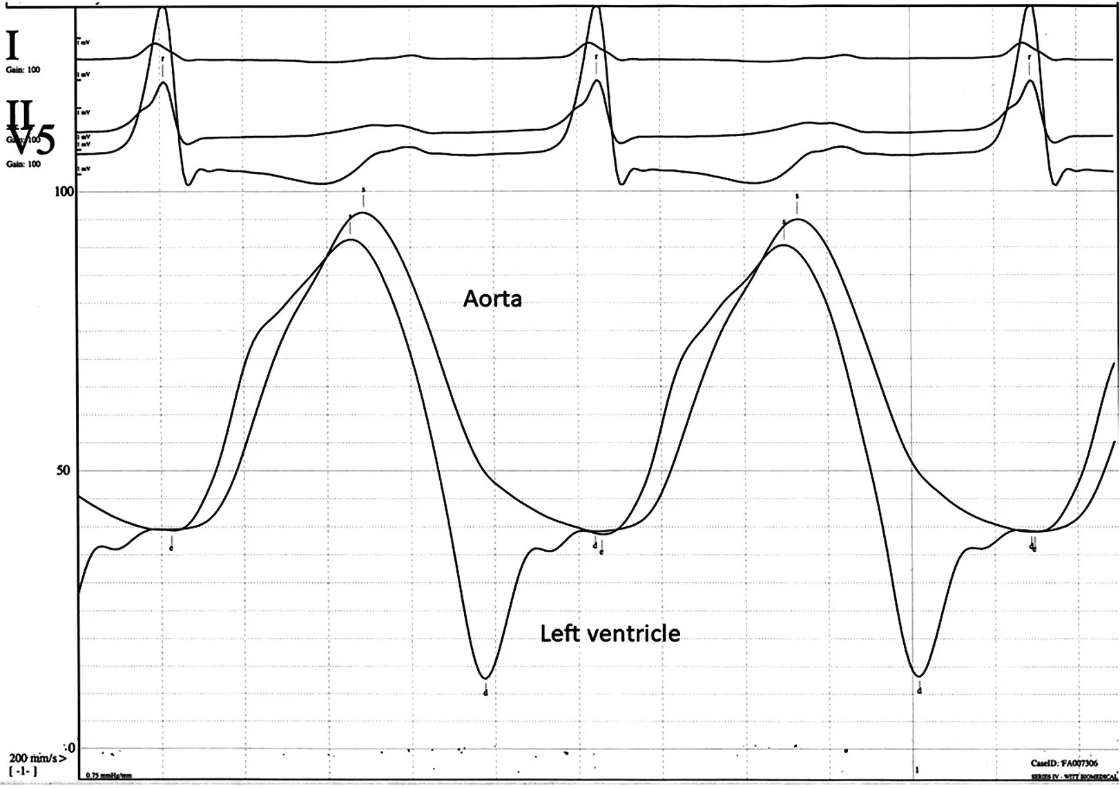 Simultaneous recording of pressures in the aortic root and left ventricle.