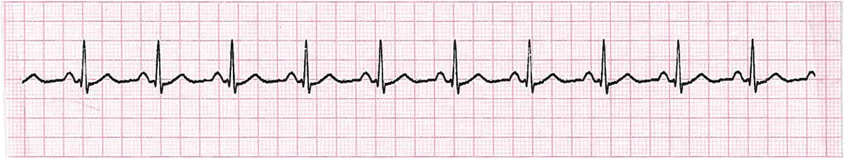 ECG tracing of a sinus rhythm.