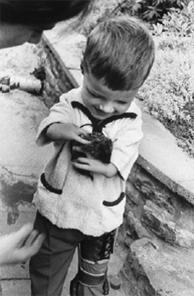 Photo of a child with thalidomide?induced phocomelia and limb defect.