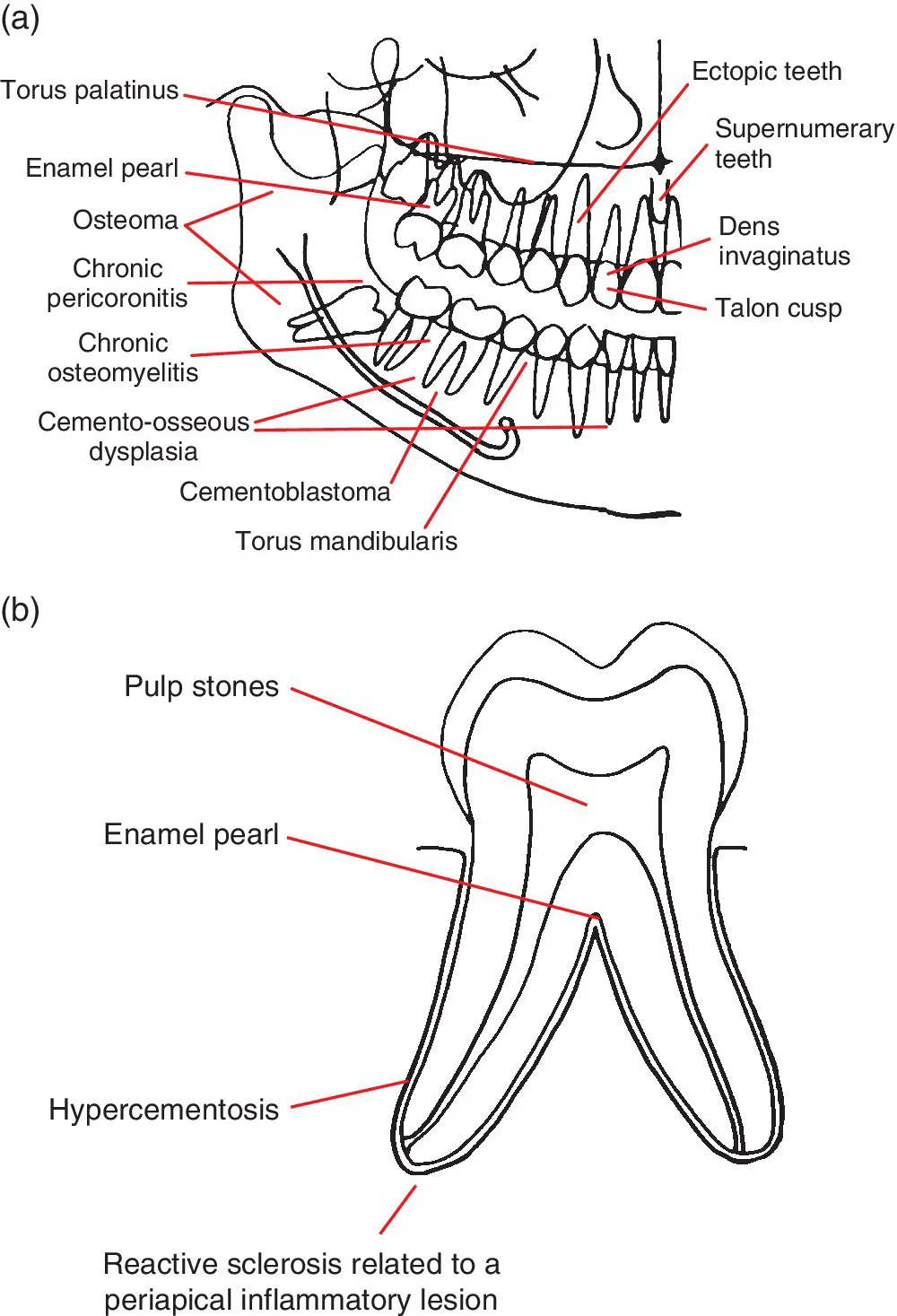Line drawing of right upper and lower jaws and teeth (top) and a fully erupted tooth (bottom), with conditions having predilection for certain jaw and tooth regions illustrated.