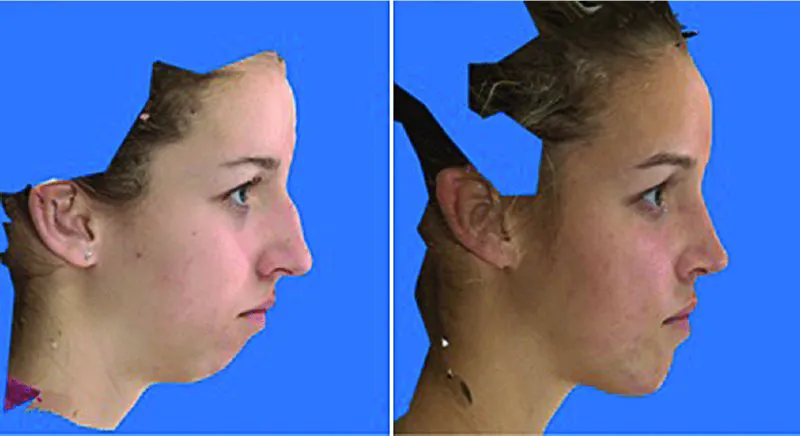A set of two pictures shows right lateral view of face of a woman representing pre- and postoperative changes in the nasal and chin projections.