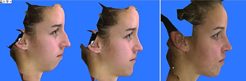 A set of three pictures shows right lateral view of face of a woman representing pre- and postoperative changes in the nasal and chin regions.