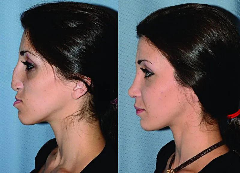 A set of two pictures shows left lateral view of face of a woman representing transformation of hooked nose and outward jaw to an upturned nose and proportionate jaw.