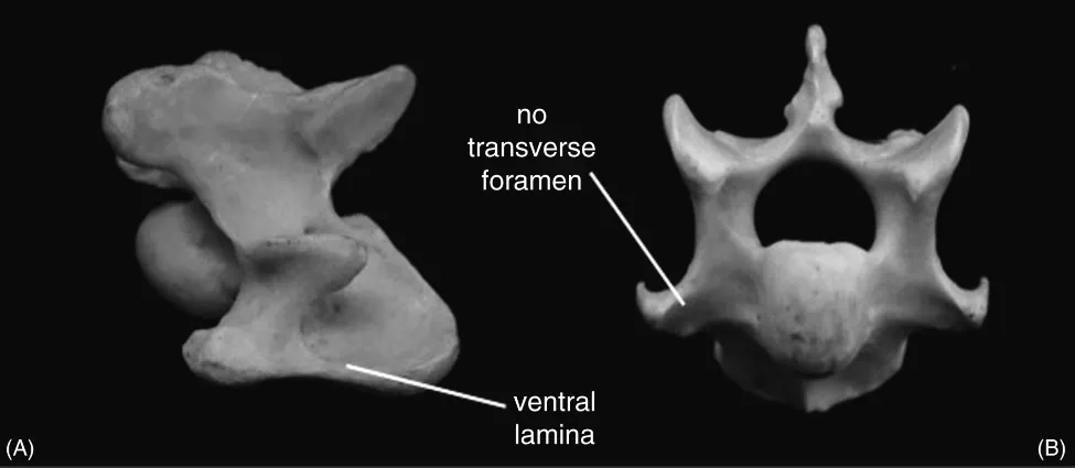 (A) Figure depicting lateral view of equine C6 vertebra, where ventral lamina is labeled. (B) Figure depicting cranial view of C7 with no transverse foramen.