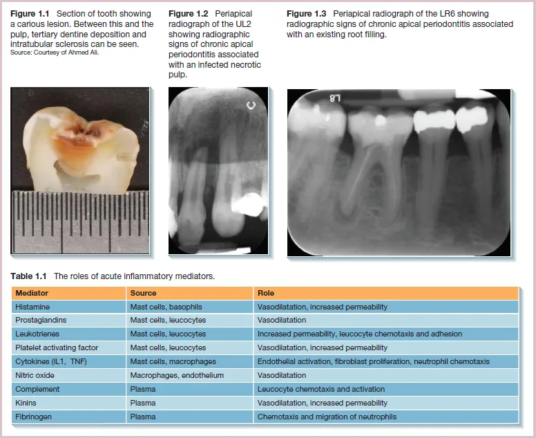 Three images; tooth section showing carious lesion; chronic apical periodontitis radiographs, one for infected necrotic pulp; other, associated with infected root filling. 
Table shows acute inflammatory mediators, their source and role.
