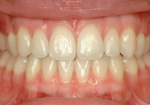 Coloured representation presents clinical photograph of a normal healthy dentition, gingivae and oral mucosa.