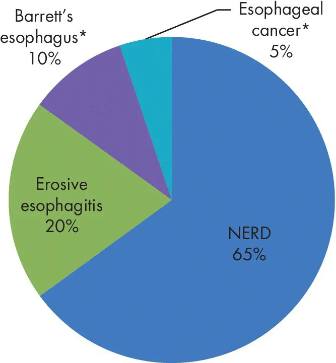 Pie chart of clinical spectrum of GERD displaying segments for NERD 65%, erosive esophagitis 20%, Esopageal cancer* 5%, Barrett’s esophagus* 10%, and functional heartburn 0%.