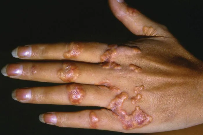 The back of a hand with tendon xanthelasma, indicating hypercholesterolemia.