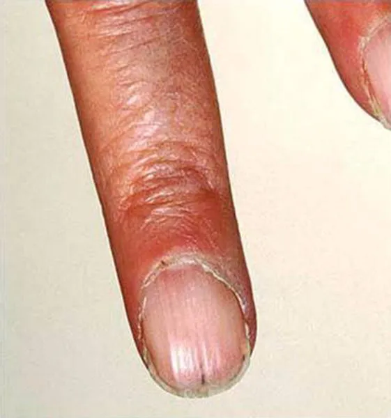 A fingernail with splinter haemorrhages.