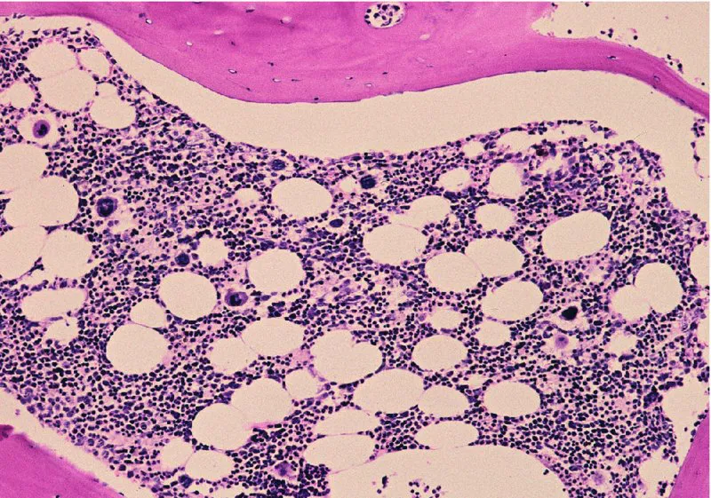 10 times magnification of Canine bone marrow core biopsy using hematoxylin and eosin stain. There are pink bony trabeculae in the lower left corner, lower right corner, and top of the photomicrograph, and surrounding the hematopoietic cells and fat. There are round to oval clear areas indicating the fat. there are also many small, round purple structures, indicating the erythrocytic and granulocytic precursor cells. The larger, densely staining purple structures distributed throughout the marrow space are megakaryocytes.