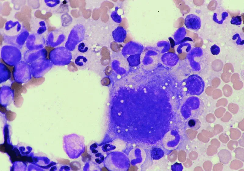 50 times magnification of canine bone marrow smear showing megakaryocyte, erythrocytic precursors, and granulocytic precursors. The megakaryocyte is the largest cell located in right center of the field. The early erythrocytic precursors have central round nuclei and deep blue cytoplasm. The early granulocytic precursors have oval to indented nuclei and blue cytoplasm. There is a granulocytic predominance in this field.