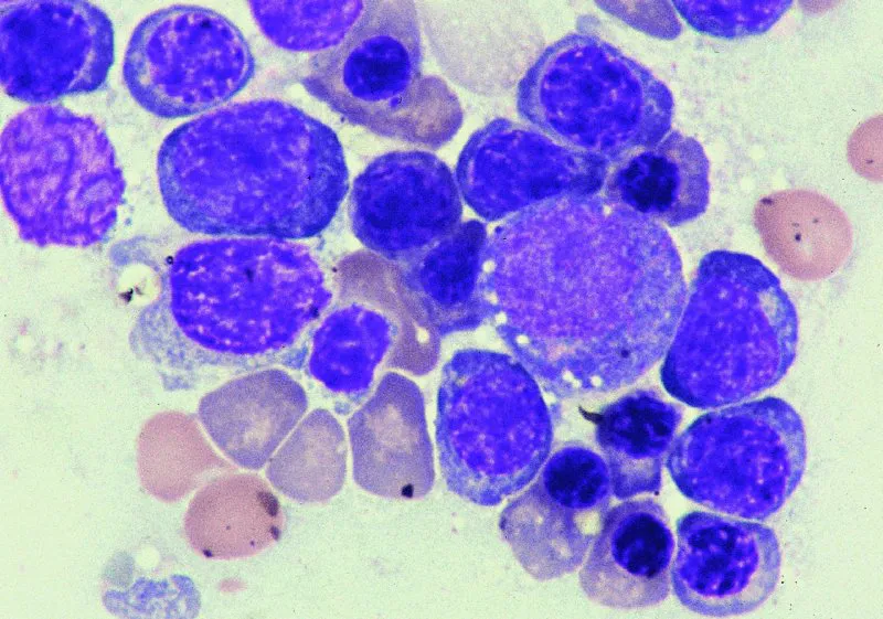 100 times magnification of canine bone marrow smear showing erythrocytic precursors. The majority of the intact cells present are early erythrocytic precursors with centrally located round nuclei and deep blue cytoplasm. The cells with round eccentrically placed nuclei and reddish blue cytoplasm are late-stage erythrocytic precursors. The largest cell in the right center of the field that has small pink granules in the cytoplasm is a promyelocyte.