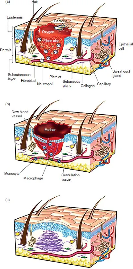 Diagram shows inflammation stage wound with labels for fibrin clot, oxygen, bacteria, platelet et cetera and wound during new tissue formation with labels for eschar, monocyte, macrophage, new blood vessel and granulation tissue.