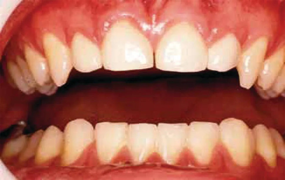 Frontal view of normal intraoral tissue and teeth.