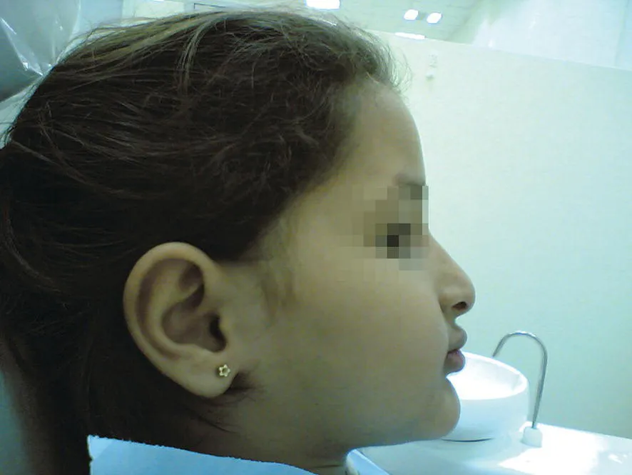 Right lateral of the head of the patient displaying lateral lip pattern in ectodermal dysplasia.