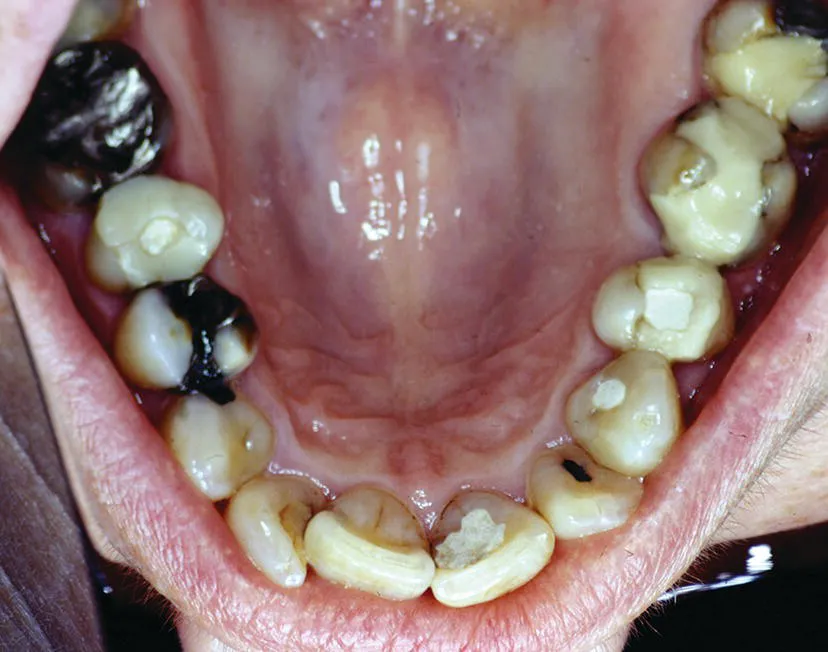 Photo of a patient's mandibular teeth presenting multiple restorations and endodontic procedures.