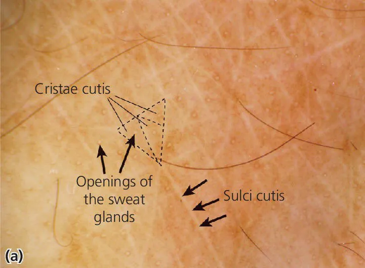 Photo displaying the appearance of the skin surface with Cristae cutis (triangle), sulci cutis and openings of the sweat glands depicted.