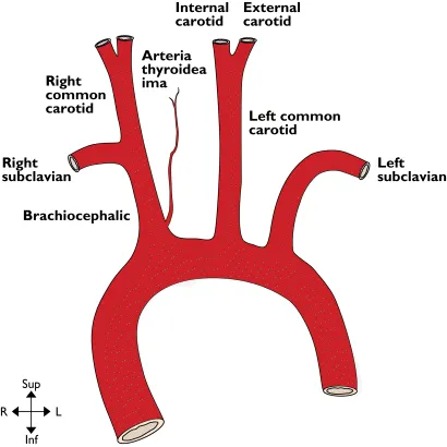 Diagram illustrating ascending and arch of aorta. The various parts labelled are brachiocephalic, right and left subclavian, right and left common carotid, thyroid ima artery and internal and external carotid. On the bottom left corner is a four-point compass rose, where the upper and lower point indicates superior and inferior, respectively. The right and the left point depicts left and right, respectively.