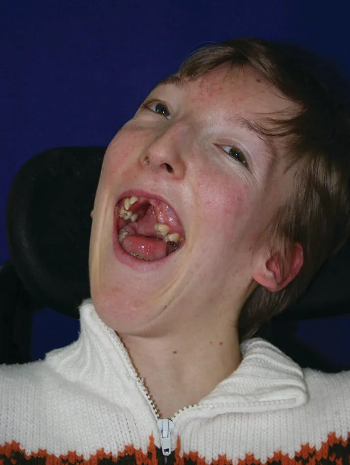 Photo of a child with a cerebral palsy head. His mouth is open, displaying his teeth.