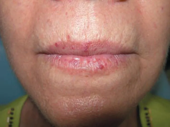Photo of a patient’s closed lips presenting hereditary hemorrhagic telangiectasia.