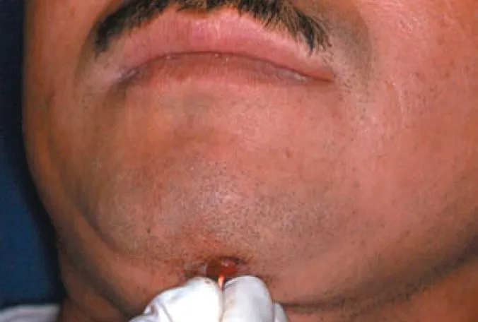 Photo of a man’s chin with a cutaneous odontogenic fistula.