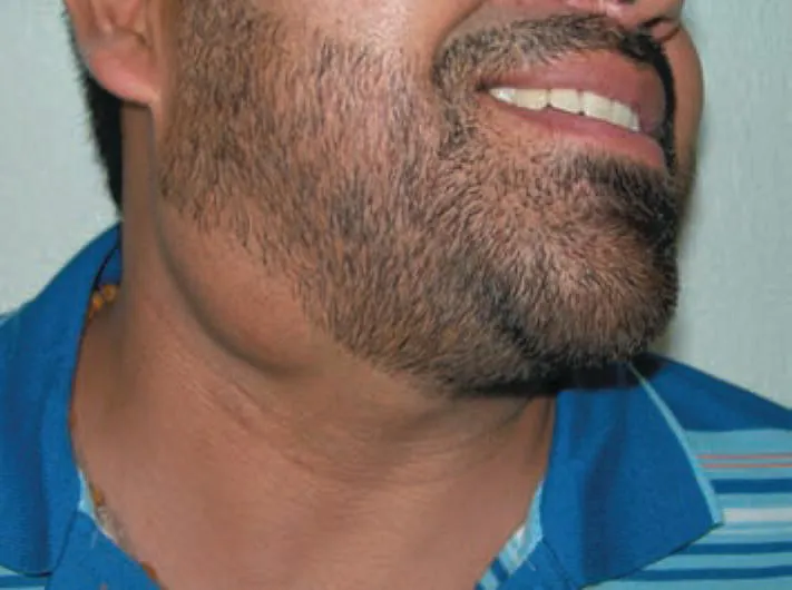 Photo of a bearded man’s neck displaying lipoma, a lump on the neck near the ear.