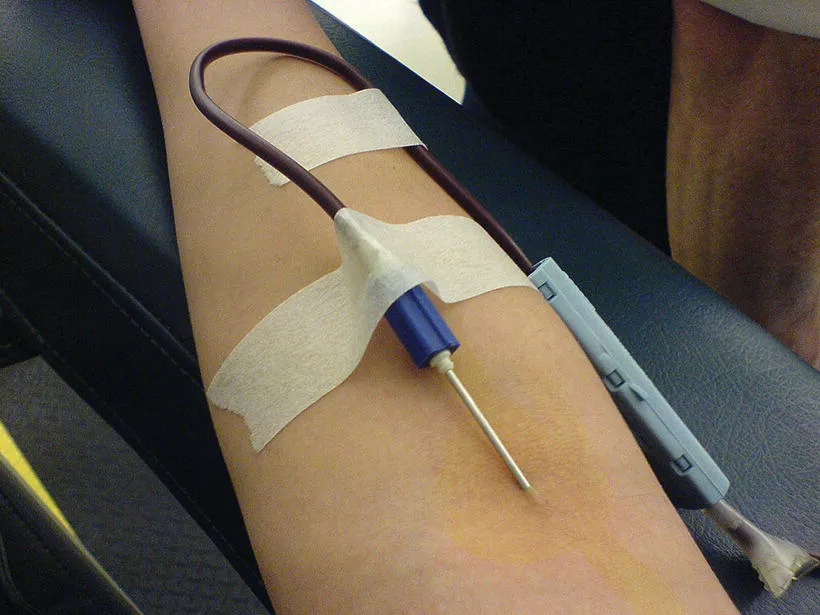 Photo of a needle inserted into the arm of the donor during blood donation.
