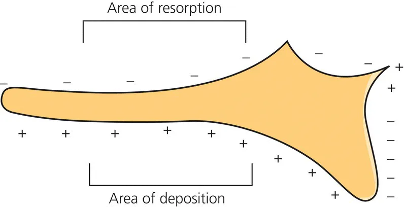 Diagram of resorption on the superior surface of the maxilla accompanied by deposition on the palate surface leading to an inferior displacement.