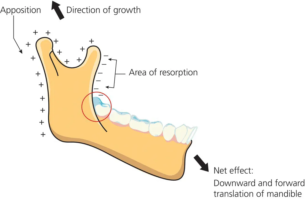 Diagram illustrating the mandibular growth via condylar growth in a posterior and superior direction resulting in downward and forward displacement, with apposition and area of deposition depicted by arrows.